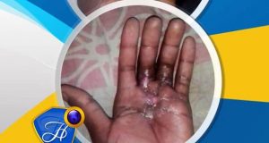 Healed Of Sepsis