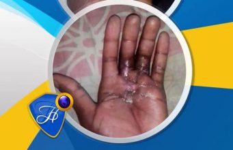 Healed Of Sepsis