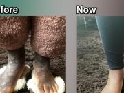 Healed Of Severe Atopic Dermatitis