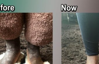 Healed Of Severe Atopic Dermatitis